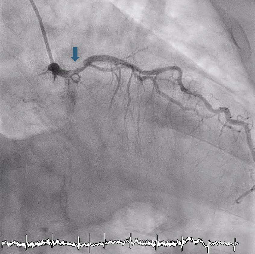 Figure 1. right anterior oblique caudal view