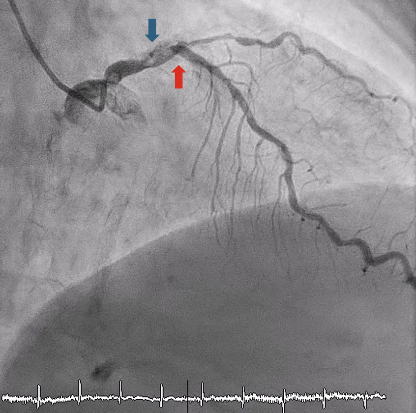 Figure 2. right anterior oblique cranial view