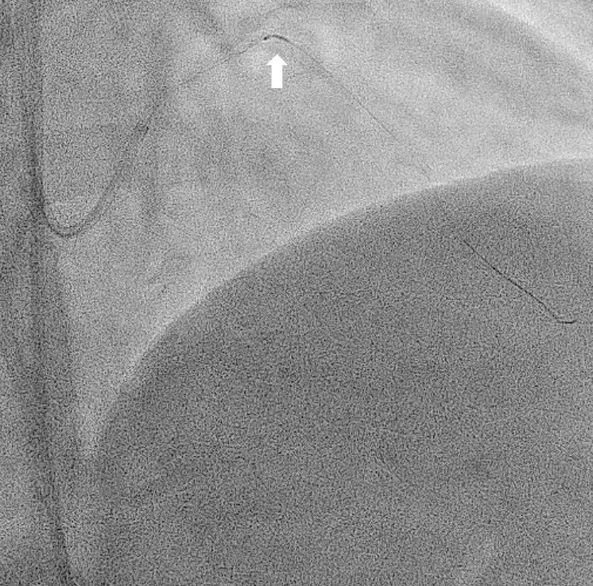 Figure 3. intravascular ultrasound
