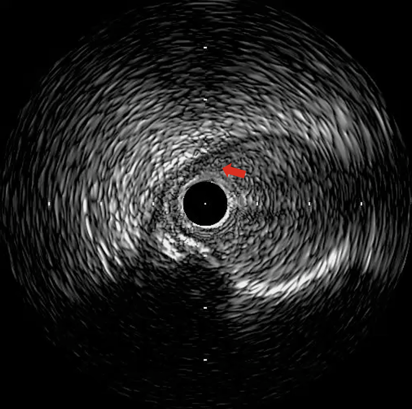 Figure 4. intravascular ultrasound
