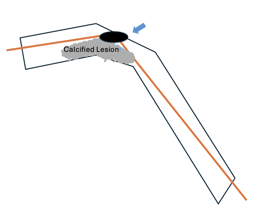 Figure 5. rotablation burr