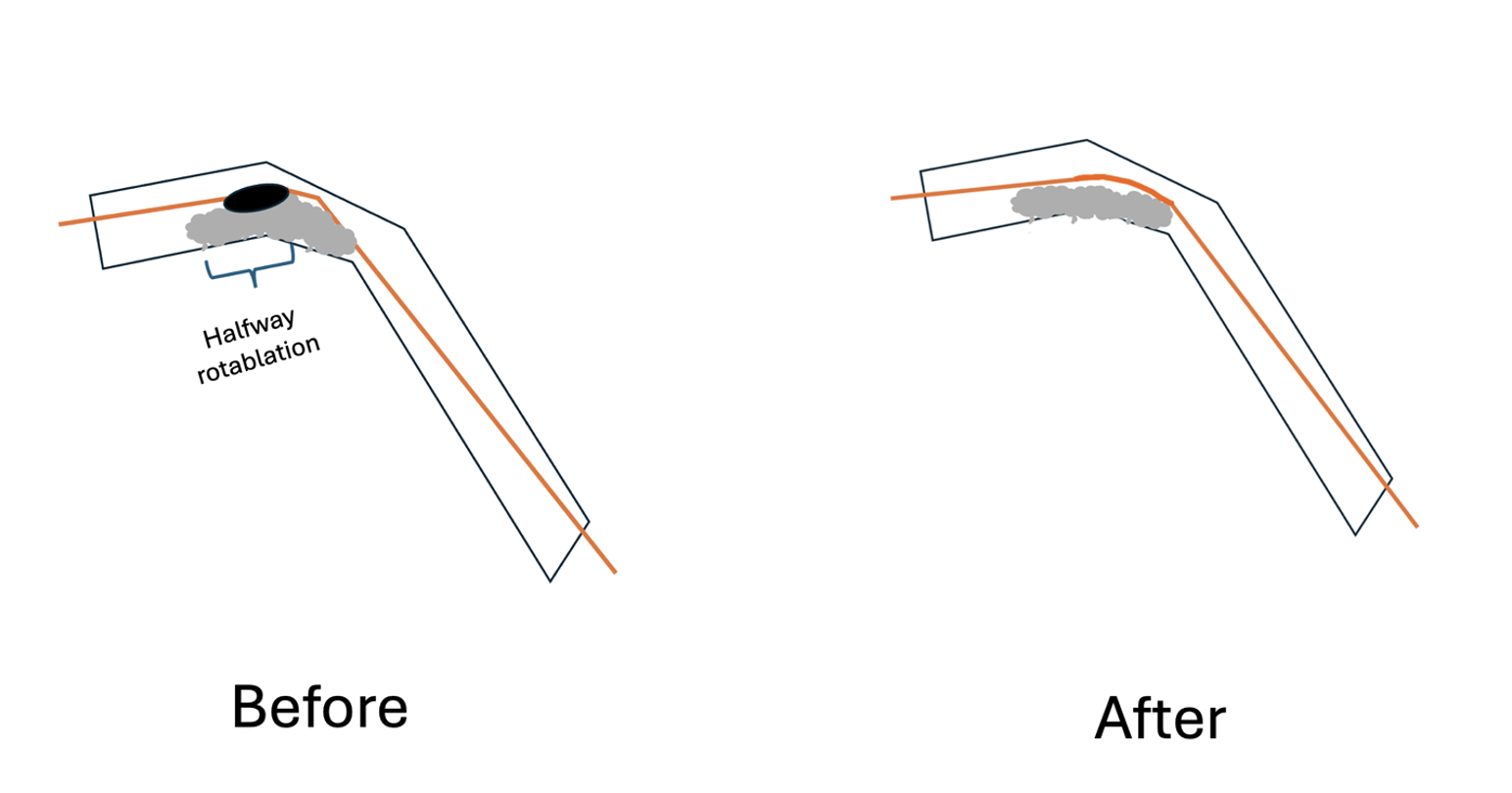 Figure 6. halfway rotablation