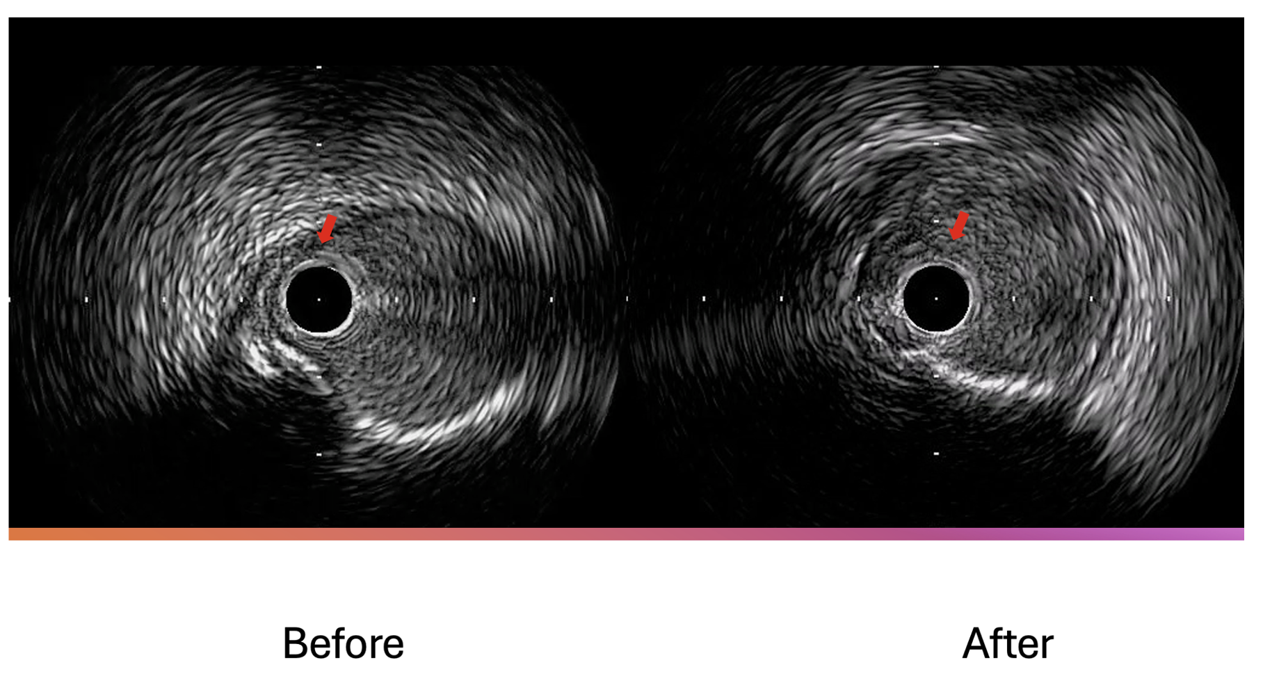 Figure 8. Intravascular ultrasound