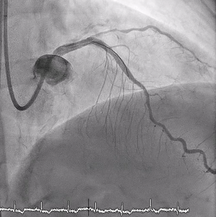 Figure 9. Final angiogram 