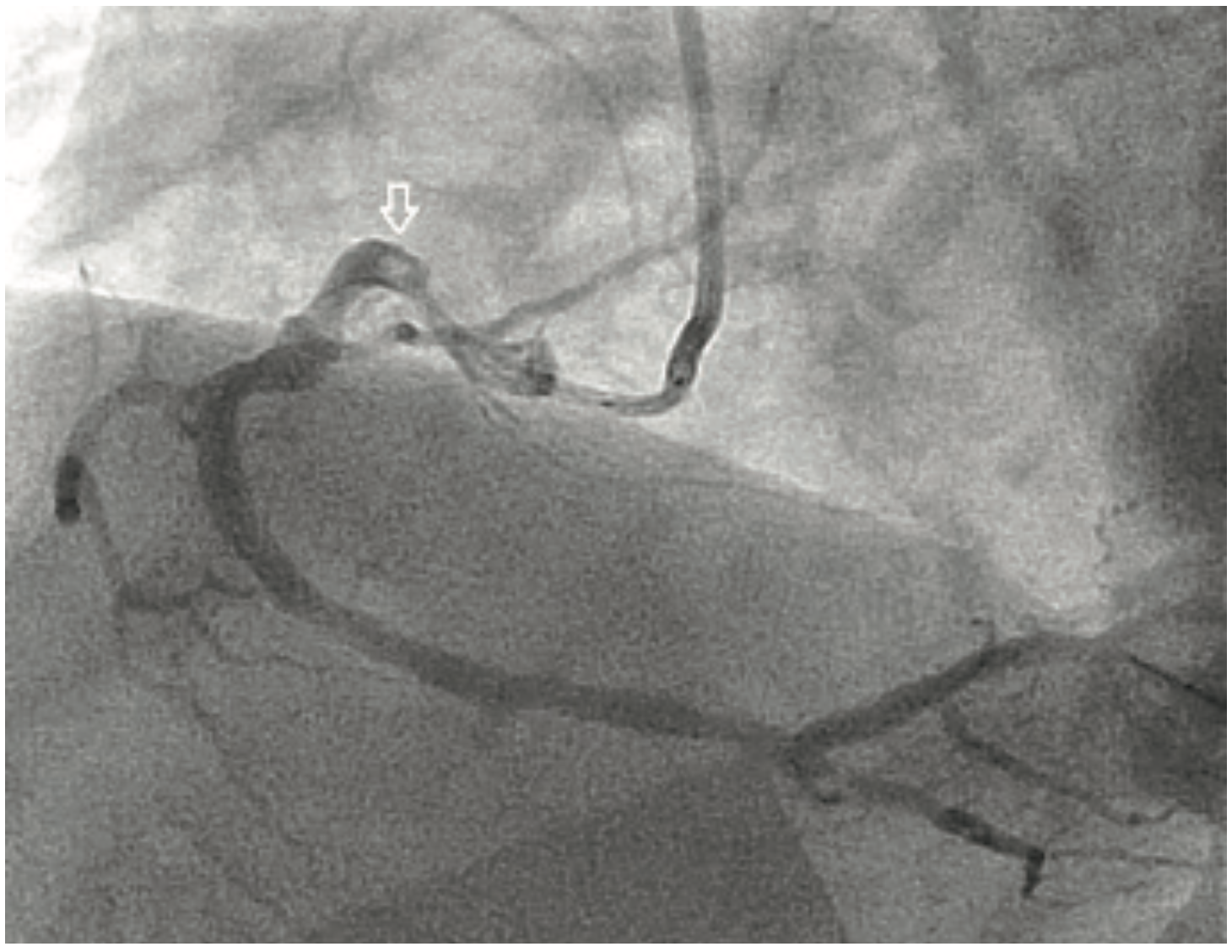 Yee Thrombectomy Figure 1