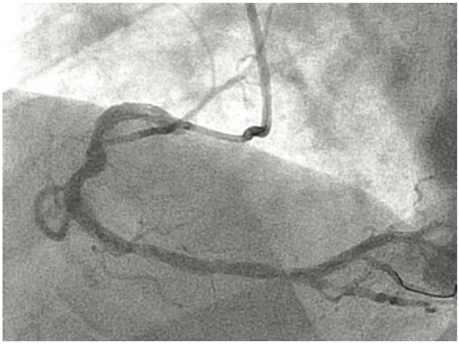 Yee Thrombectomy Figure 2
