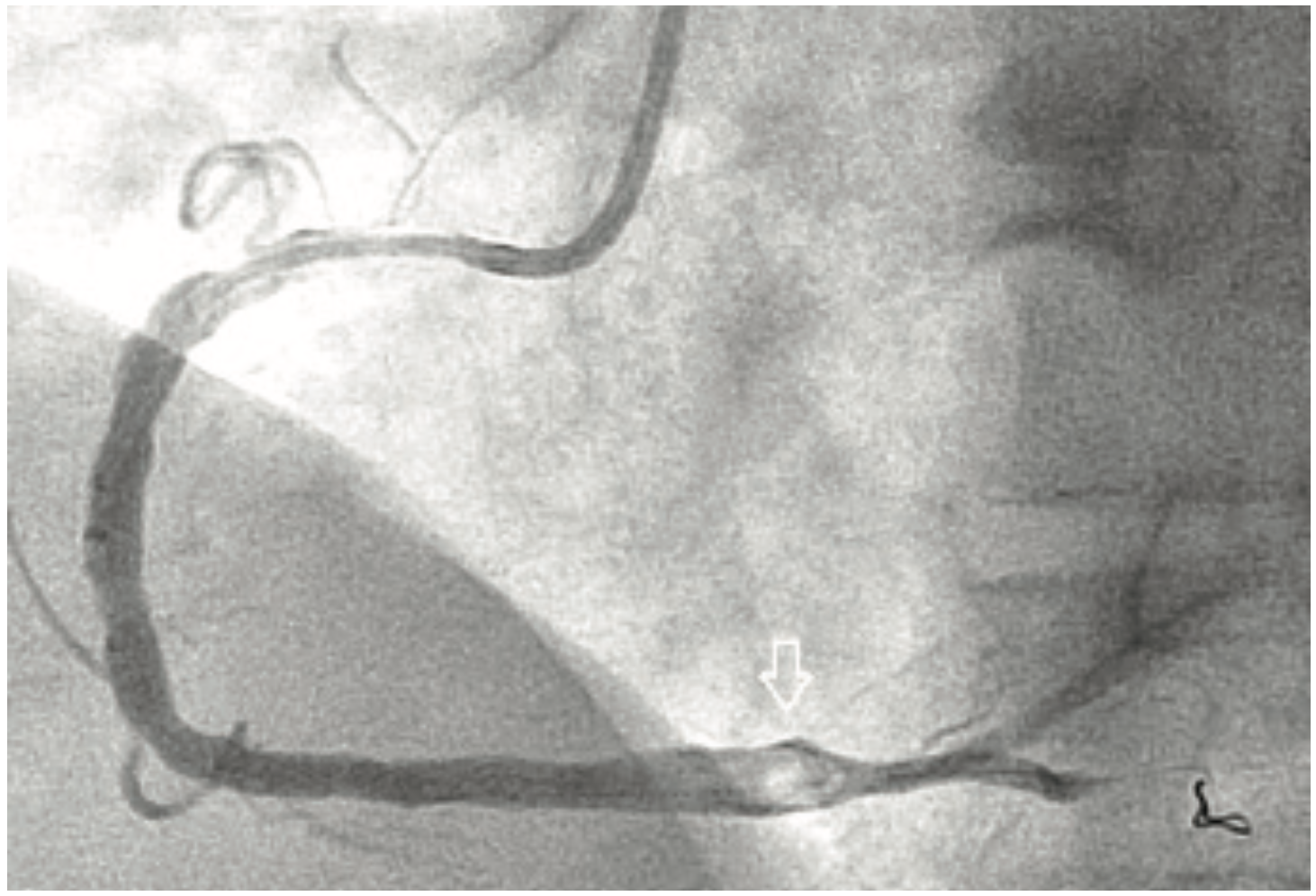 Yee Thrombectomy Figure 3