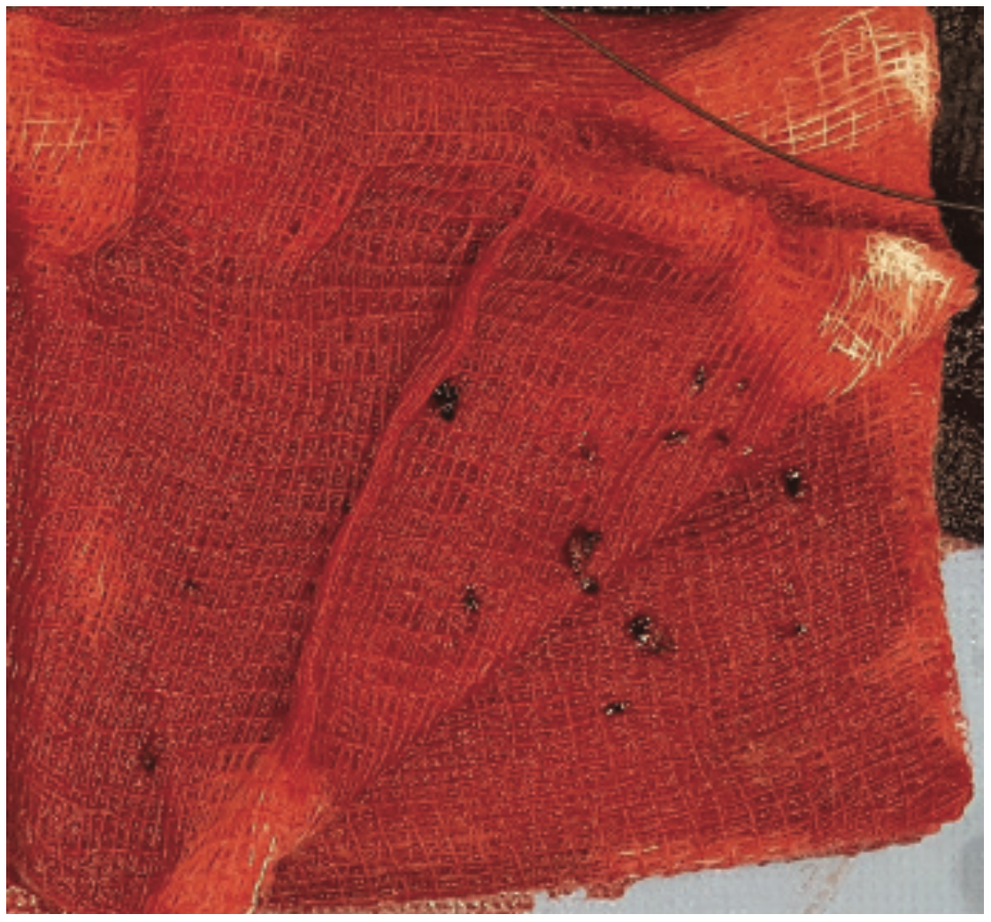 Yee Thrombectomy Figure 6