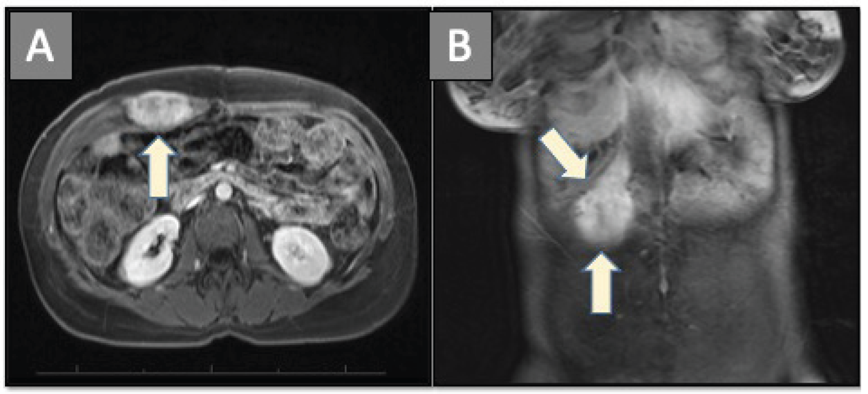 Yevich Cryo Abdominal Wall Desmoid Fig1