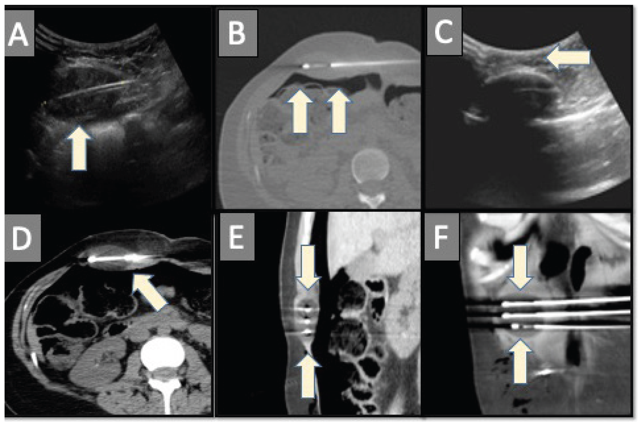 Yevich Cryo Abdominal Wall Desmoid Fig 2
