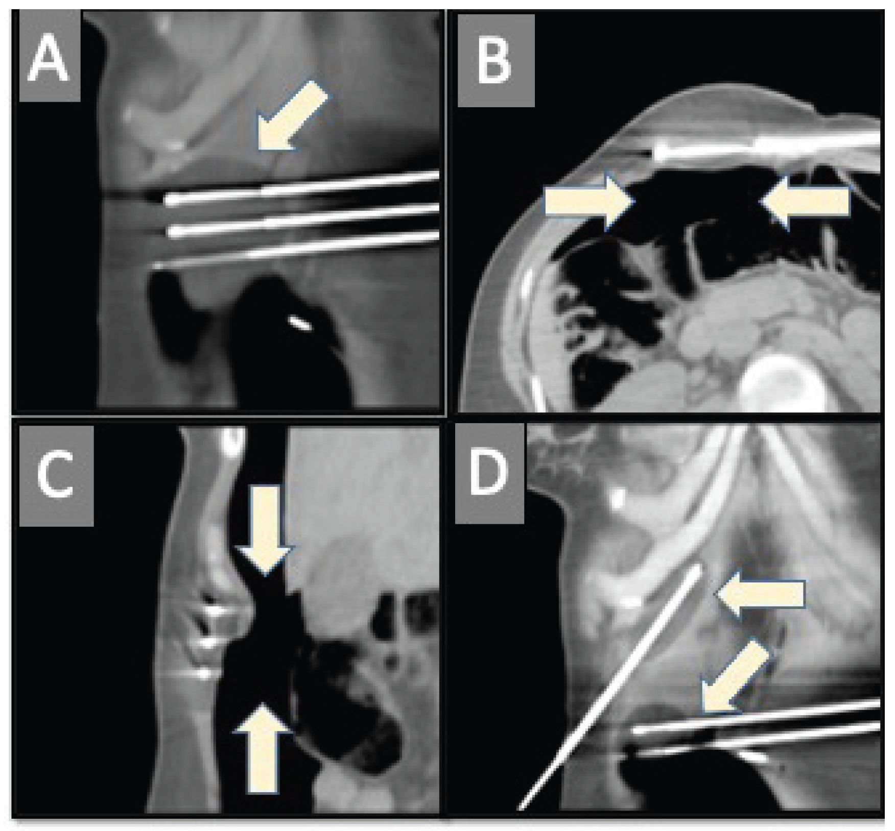Yevich Cryo Abdominal Wall Desmoid Fig 3