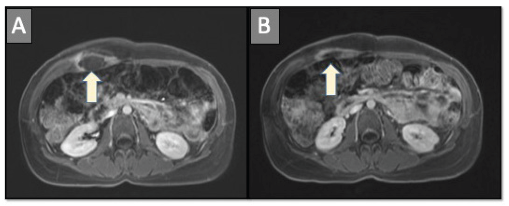 Yevich Cryo Abdominal Wall Desmoid Fig 4