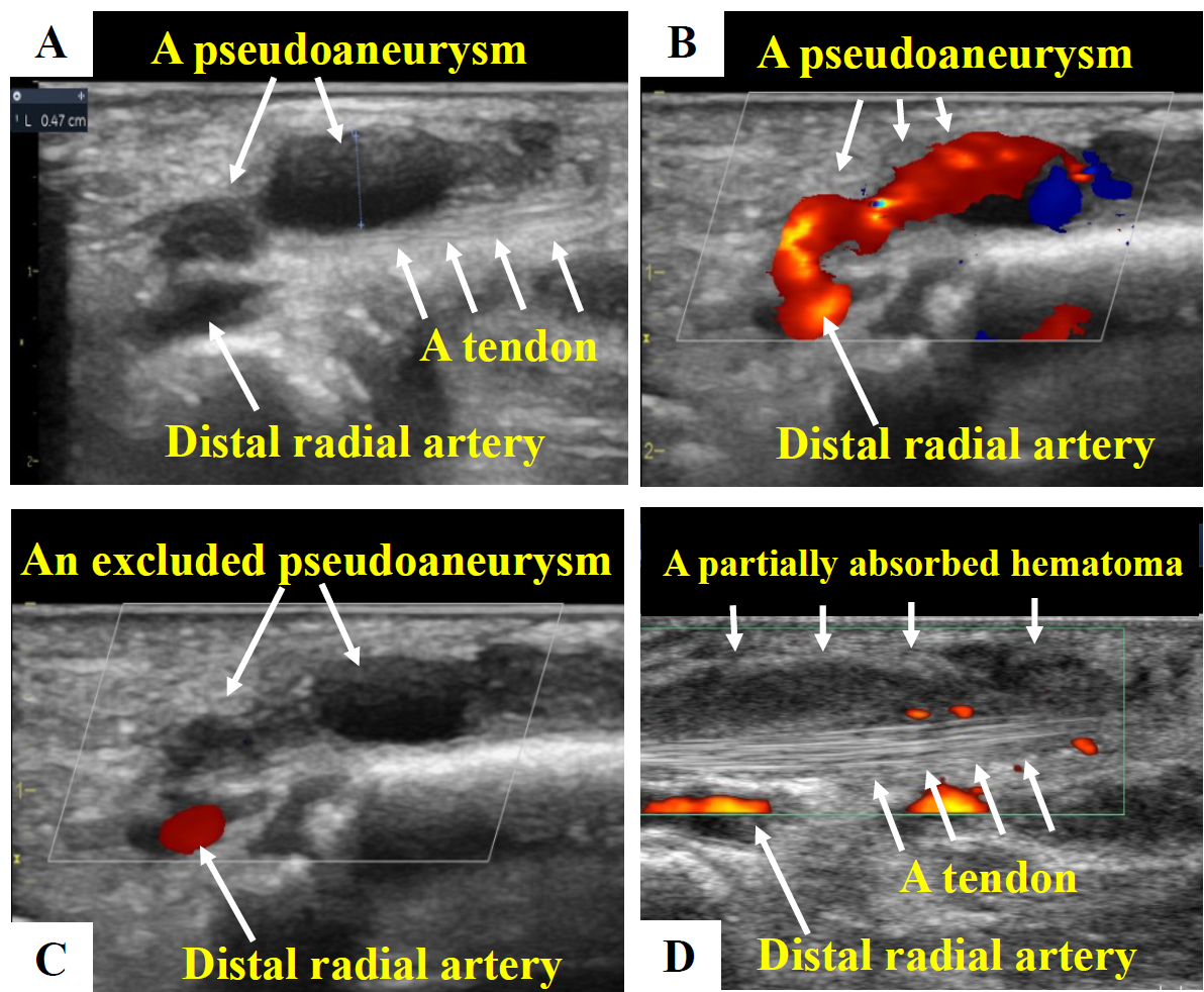 Figure. The pseudoaneurysm and tendinitis.