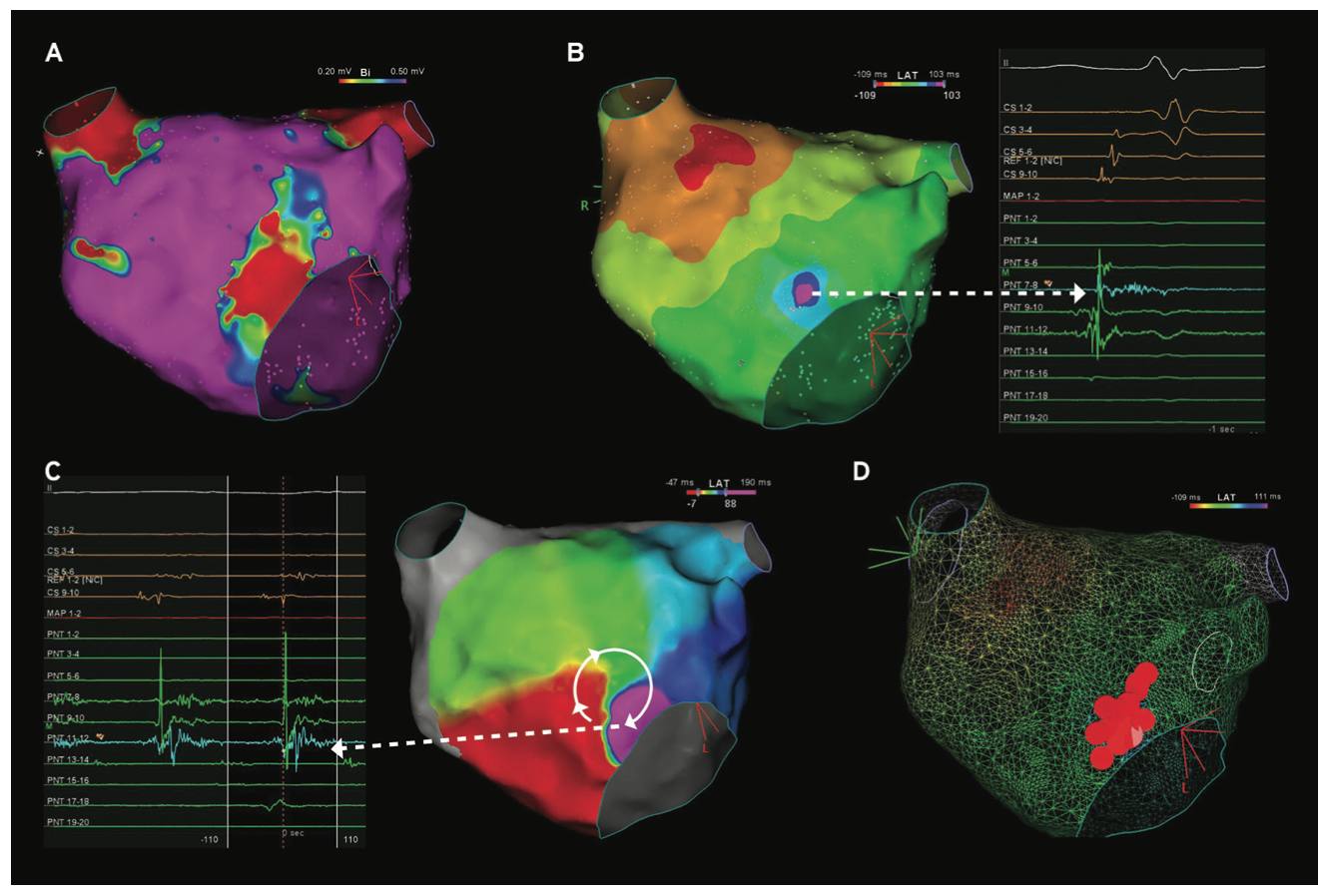 Yorgun Atrial Tachycardia Figure 1