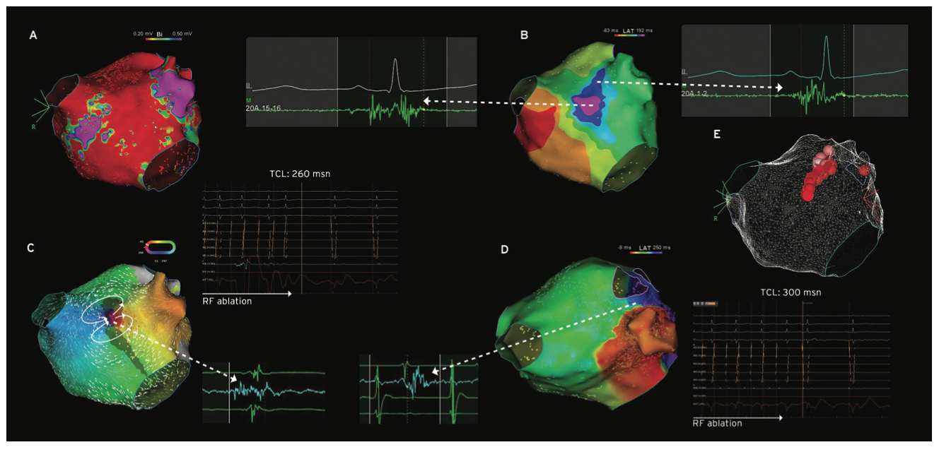 Yorgun Atrial Tachycardia Figure 2