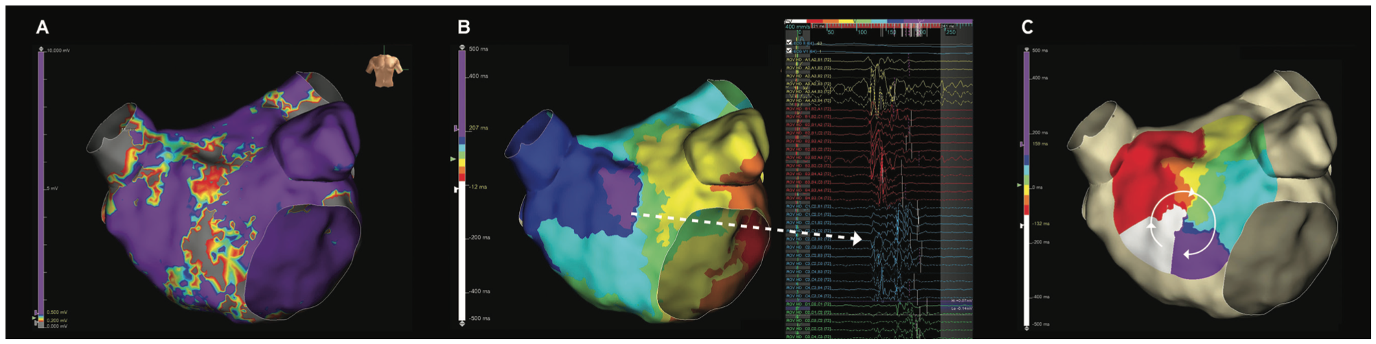 Yorgun Atrial Tachycardia Figure 3