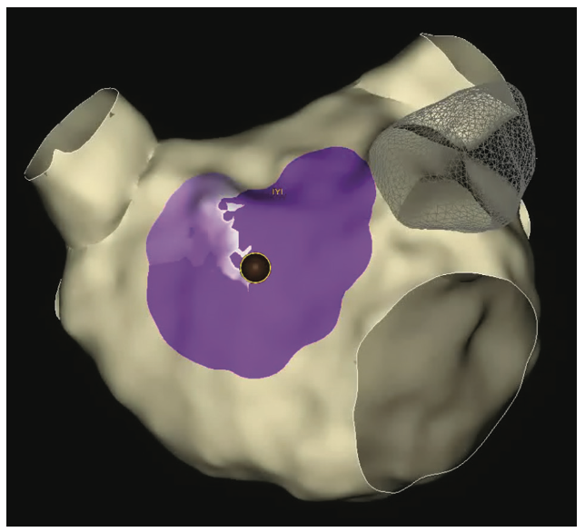 Yorgun Atrial Tachycardia Figure 4