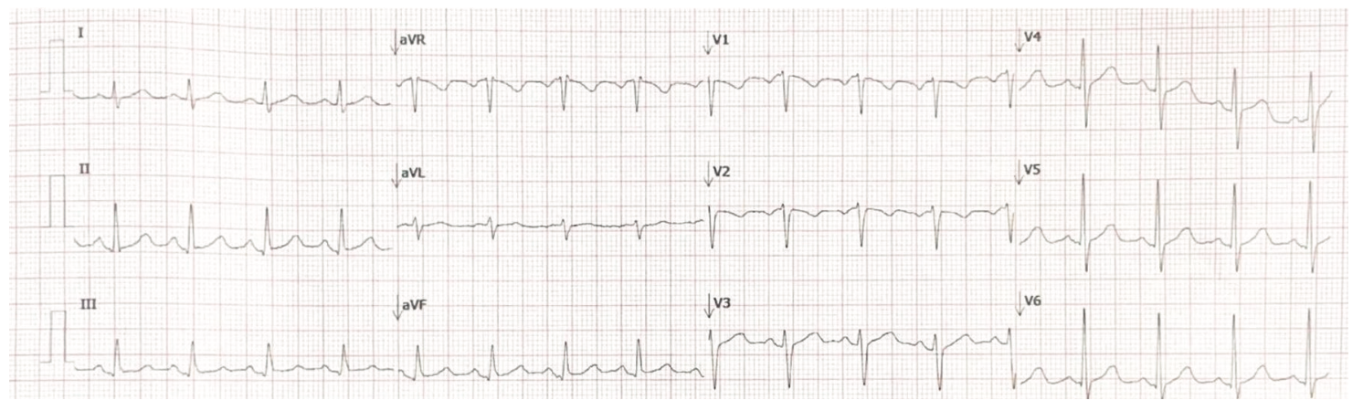Zahren-Cohen Orthostatic Tachycardia Figure 1