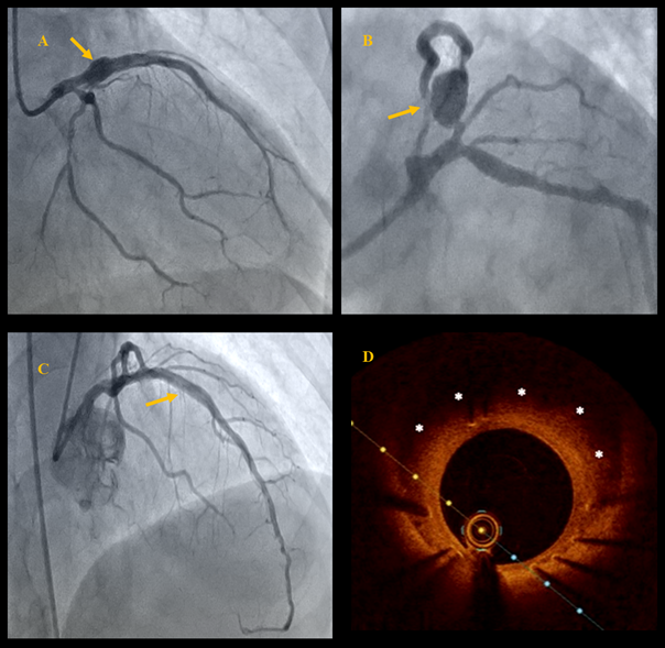 Figure. Successful treatment of coronary aneurysm 