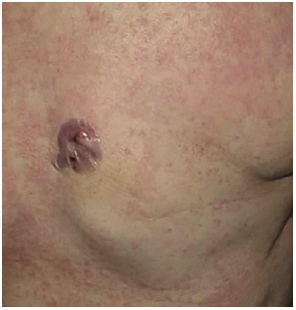 Zeroka Cardiac Implantable Figure 2