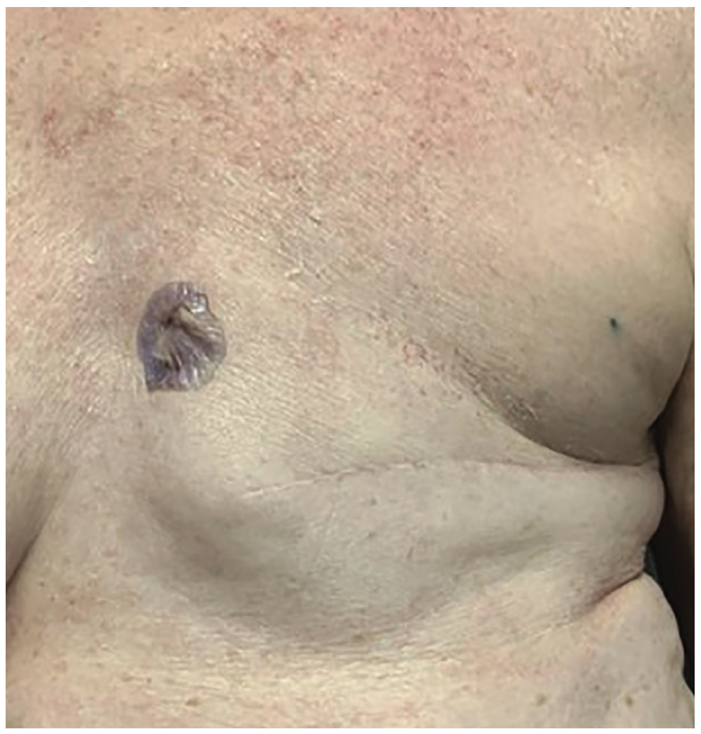 Zeroka Cardiac Implantable Figure 3