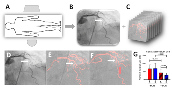 Figure 1. Generation and use of a dynamic coronary roadmap