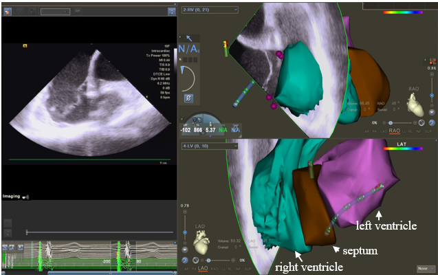 Figure. (A) Intracardiac echocardiography constructs a 3-dimensional geometry model of the heart’s anatomic structures. 