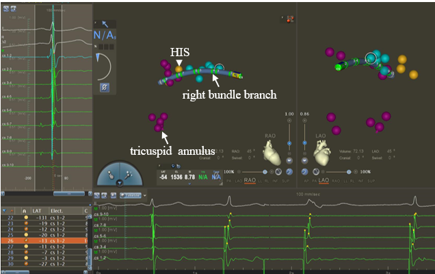 Figure. (B) The potential of the conduction system is mapped by an electrophysiology catheter. 
