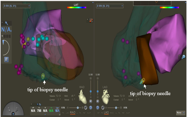 Figure. (D) Visualization of the biopsy needle on the electroanatomical mapping system (EAM) system. The tip of the biopsy needle is represented by the yellow circle in the EAM system.