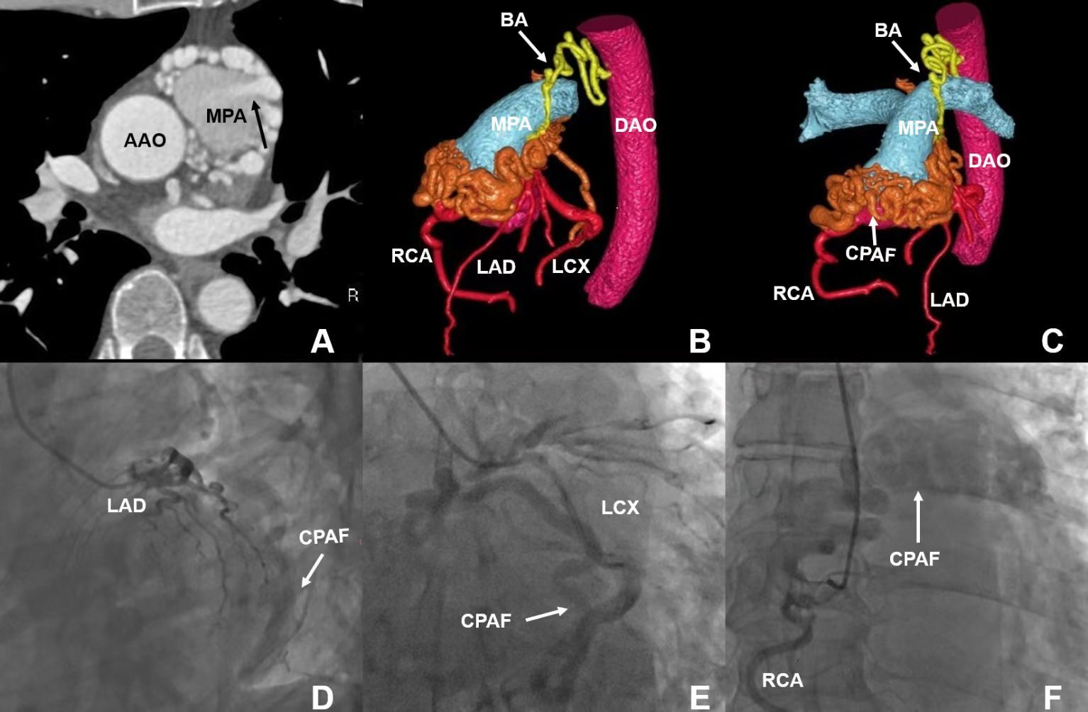 Figure. (A) Axial CCTA 