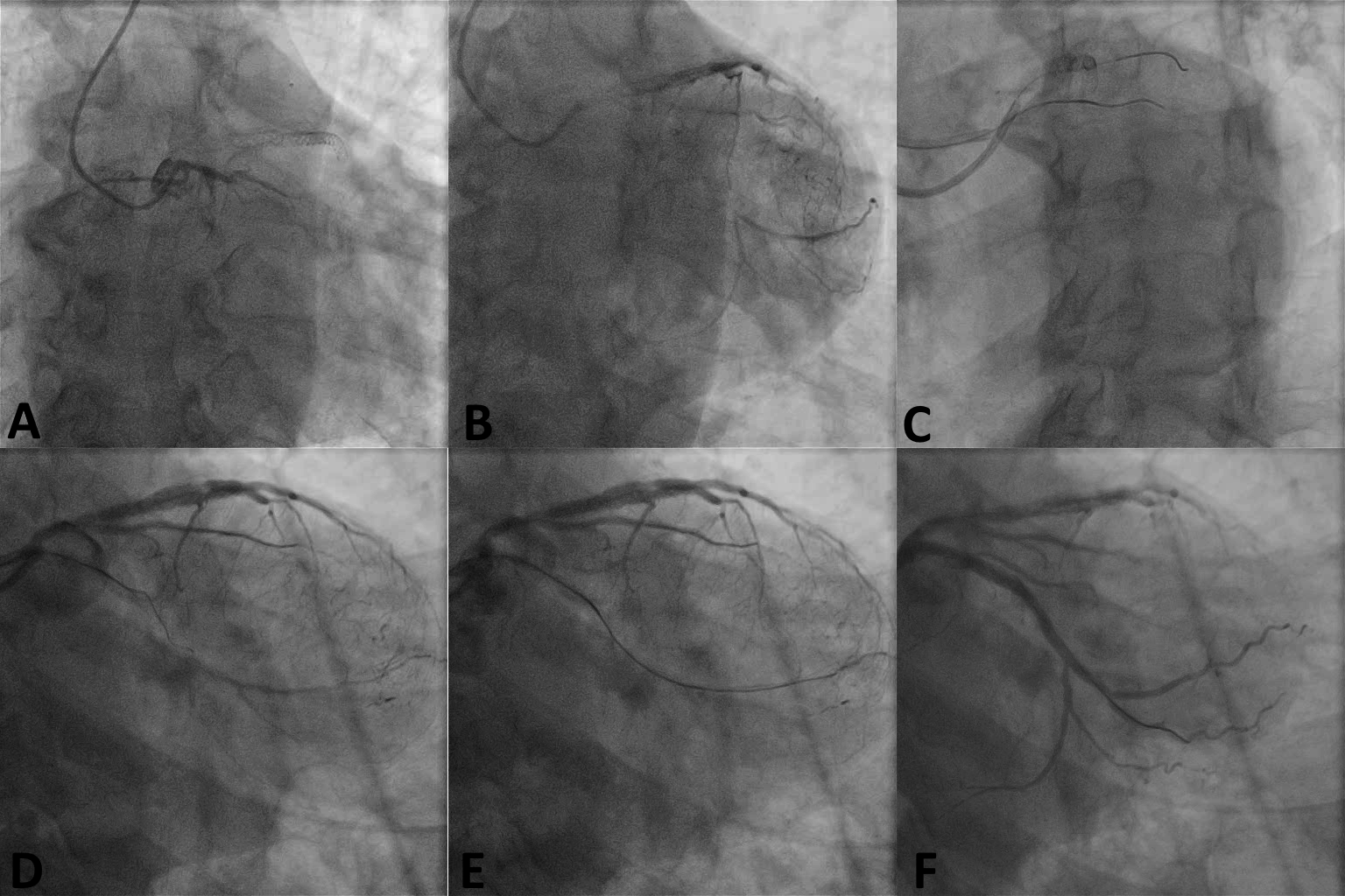  Figure. Coronary angiogram