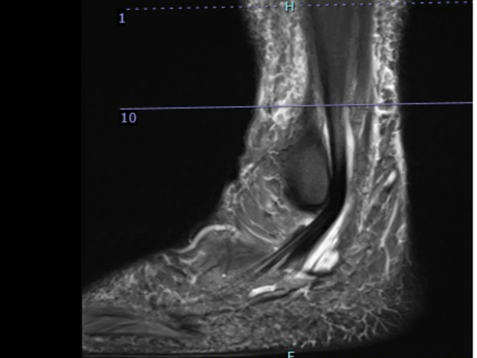 Sagittal MRI