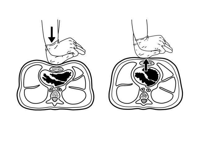 Chest compressions