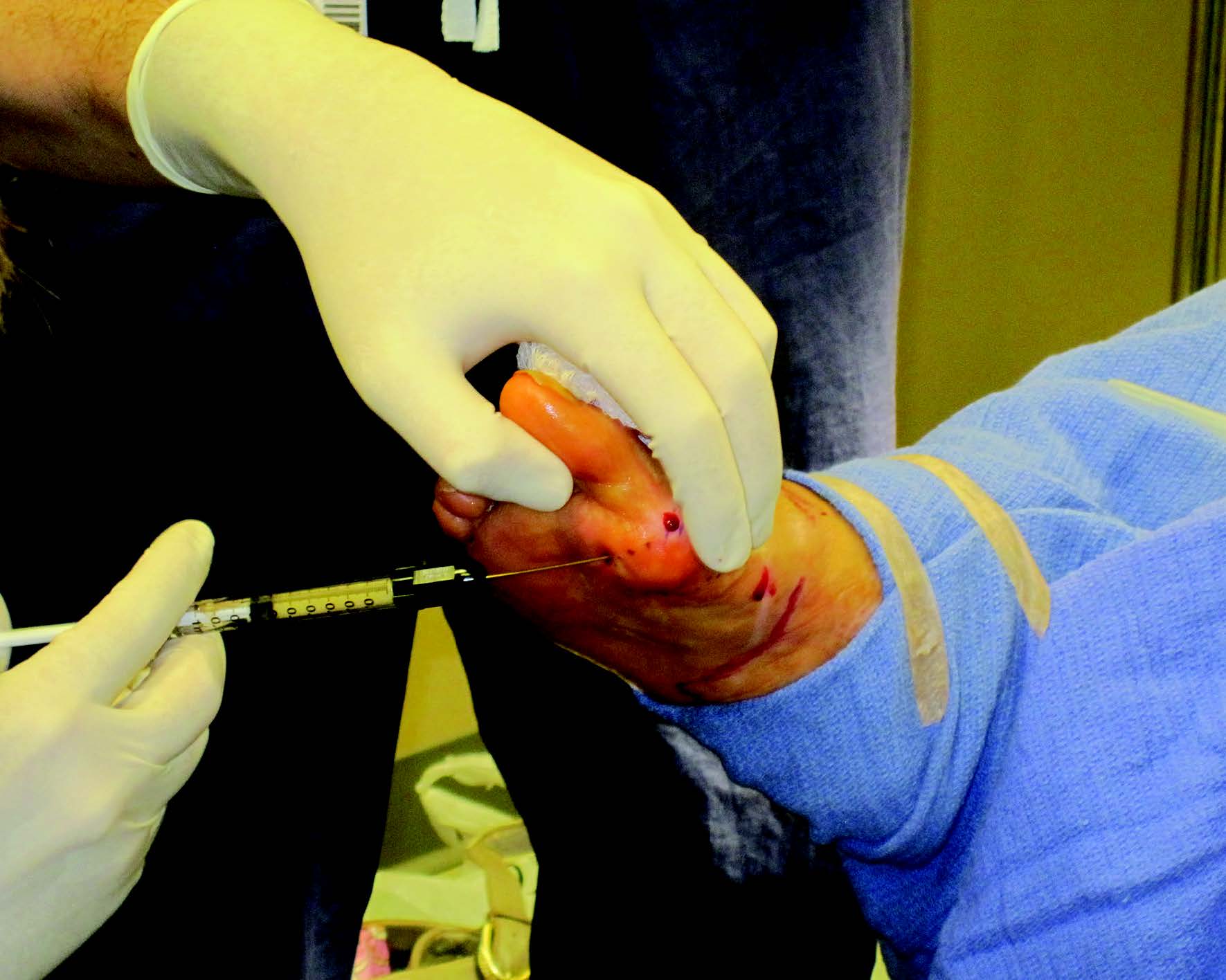 One potential example of “homologous use” of a HCT/P is utilization of adipose tissue to fill atrophied areas, as the tissue functions to provide cushioning and support to the area,5 as seen in the photo above. Homologous use is one of the requirements for a product to earn designation as a 361 HCT/P.7