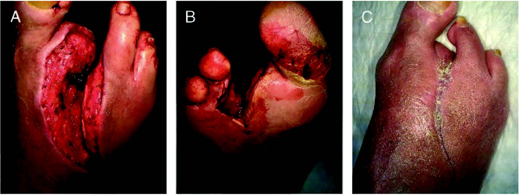 Here one can see an open wound with exposed bone following partial ray resection. The baseline wound measured 113.6 cm2 (A and B). Use of a 361 HCT/P human acellular dermal matrix (Dermacell AWM,  LifeNet Health, Virginia Beach, VA) resulted in a 79 percent reduction in wound size at 16 weeks with subsequent wound resolution (C).
