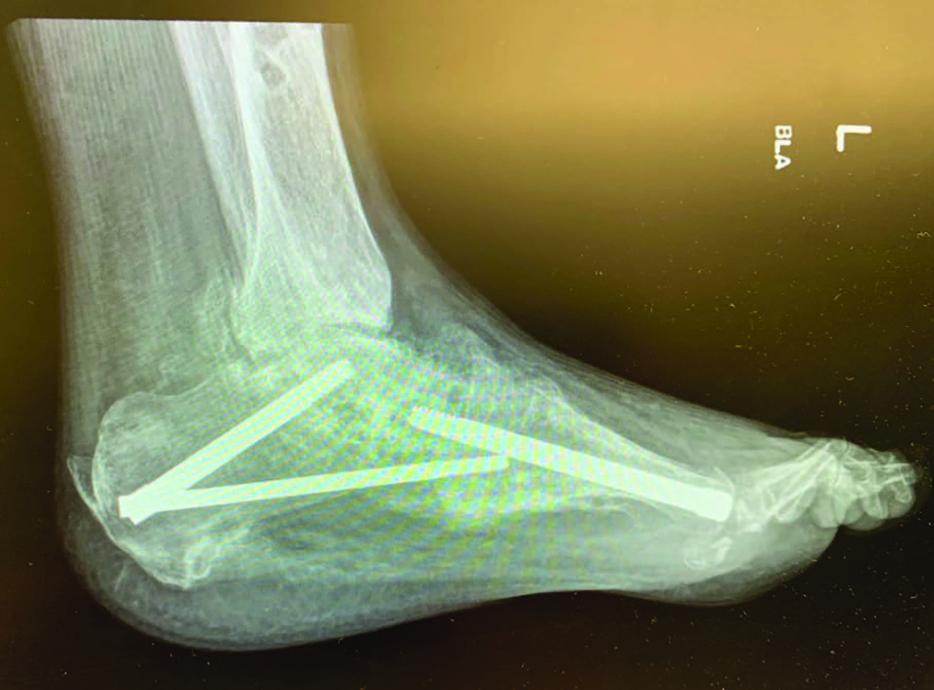 Diabetes Watch: Charcot