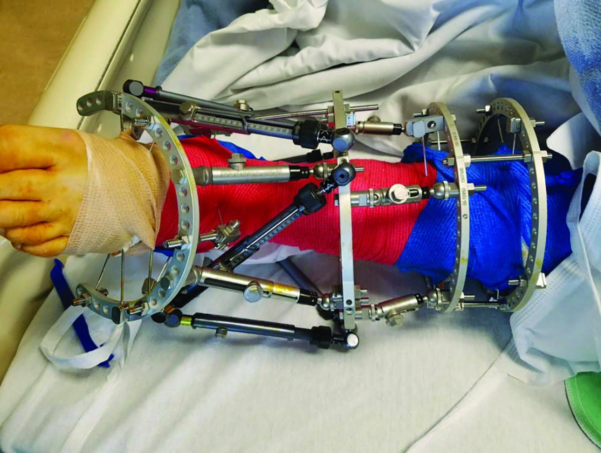 Diabetes Watch: Charcot