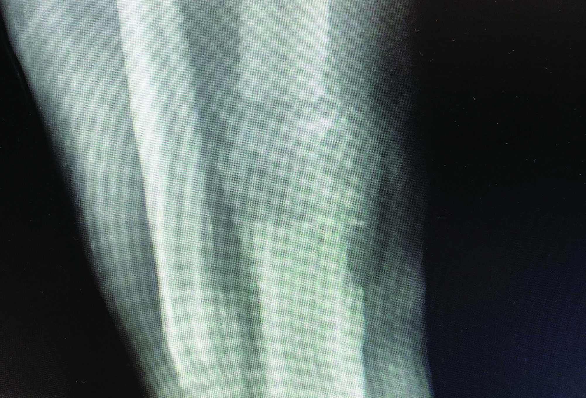 Diabetes Watch: Charcot