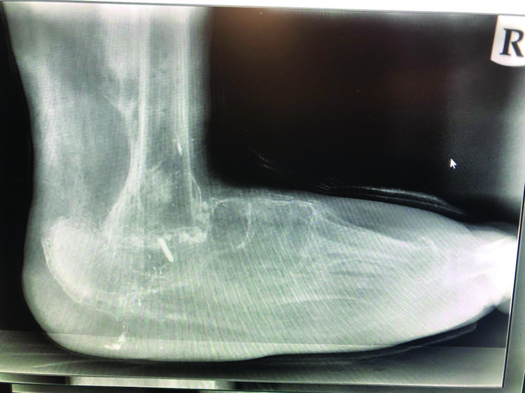 Diabetes Watch: Charcot