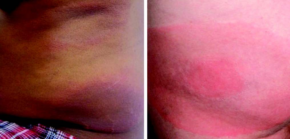 EM on dark (A) and light (B) skin. Note: EM may present di  erently than depicted in these images