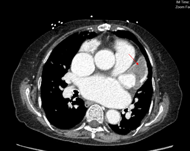 Figure 1. Computed tomography showing a large thrombus  