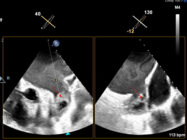 Figure 2A: Transesophageal echocardiogram  