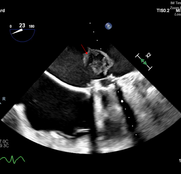 Figure 2B. Transesophageal echocardiogram