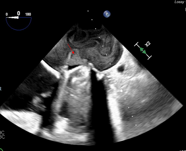 Figure 2C. Transesophageal echocardiogram 