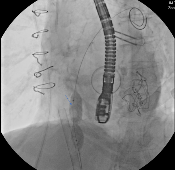 Figure 3. Fluoroscopy