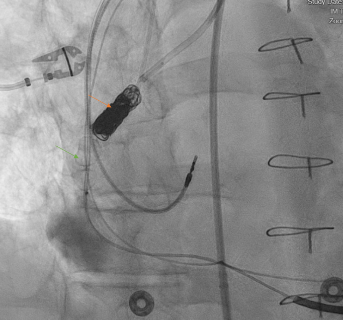 Figure 3. Final angiogram