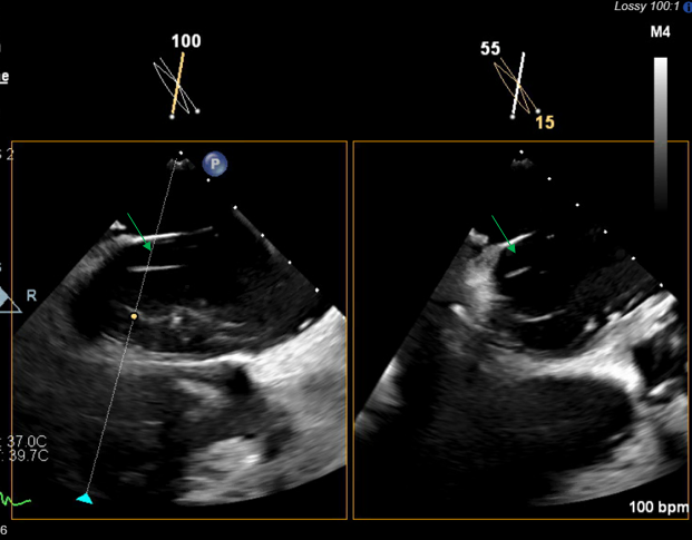 Figure 4. Transesophageal echocardiogram 