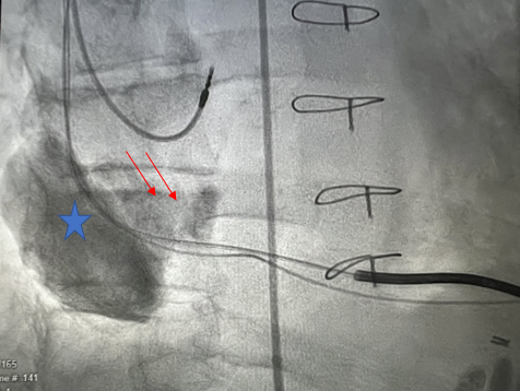 Figure 1. Angiogram showing a large saphenous venous graft aneurysm 