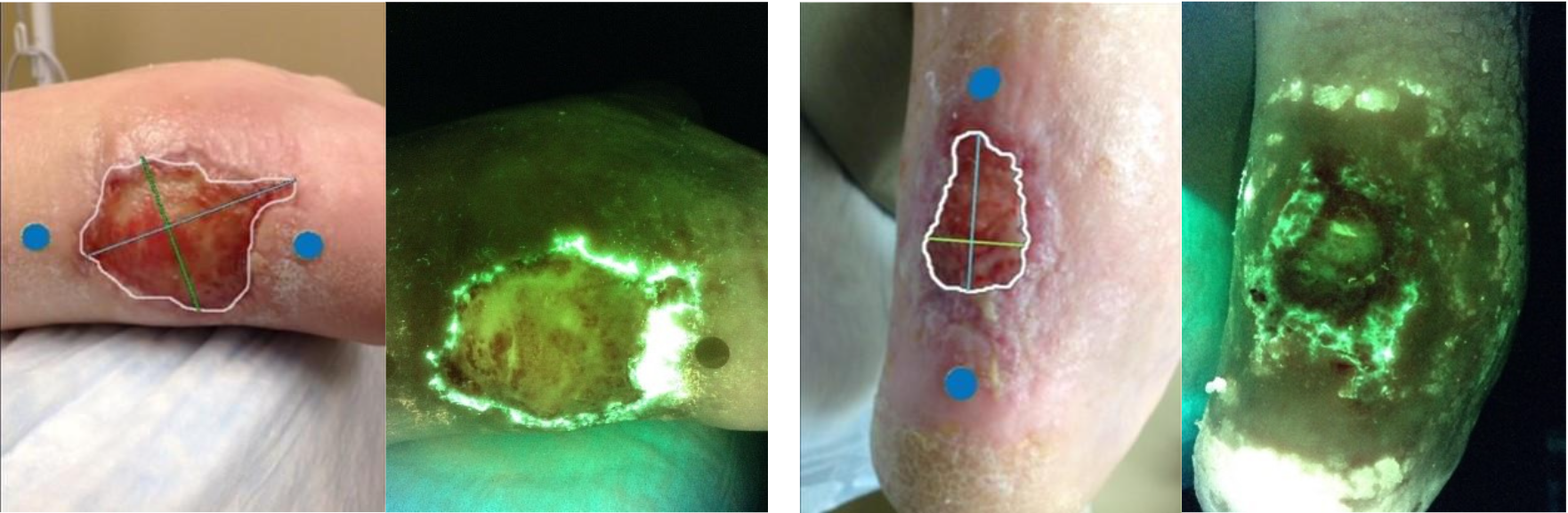 Figure 3. Standard and fluorescence images at baseline (left) and week 6 (right) for oatient 1. At baseline, the standard image measured the wound at 12.06 and 4.68 cm2 at week 6. At baseline, the fluorescence image displayed that the wound was FL+ in both the wound and periwound regions and was negative in both regions at week 6.