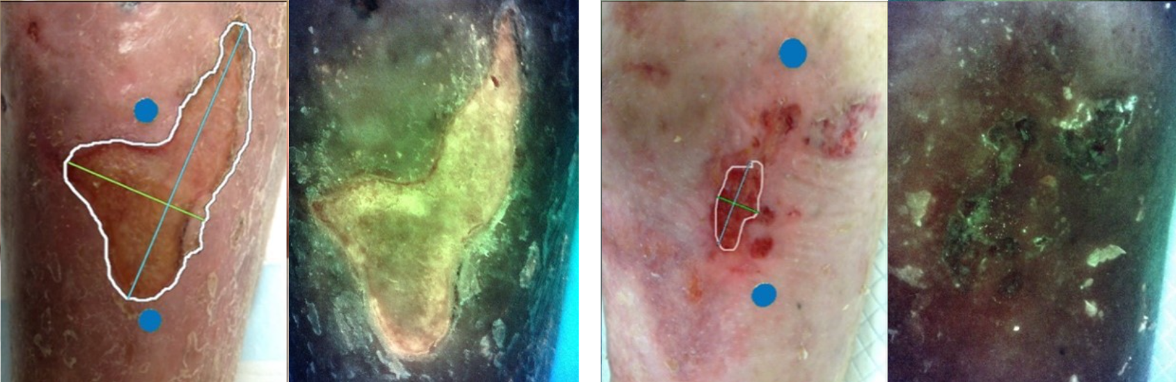 Figure 4. Standard and fluorescence images at baseline (left) and week 6 (right) for patient 3. At baseline, the standard image measured the wound at 18.21 and 1.74 cm2 at week 6. At baseline, the fluorescence image displayed that the wound was FL+ in both the wound and periwound regions and was negative in both regions at week 6.